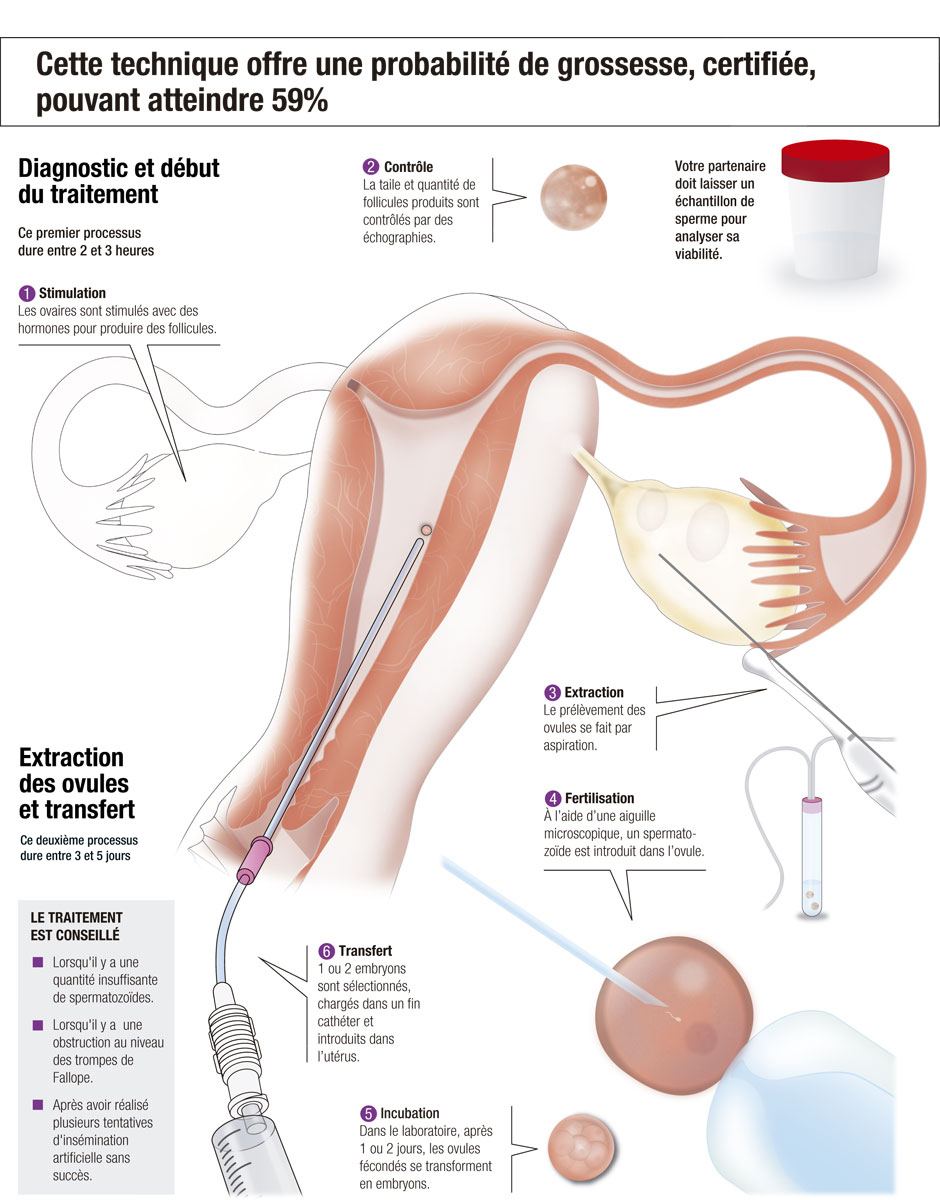 La fécondation in vitro avec vos propres ovules et le sperme de votre partenaire, expliquée étape par étape