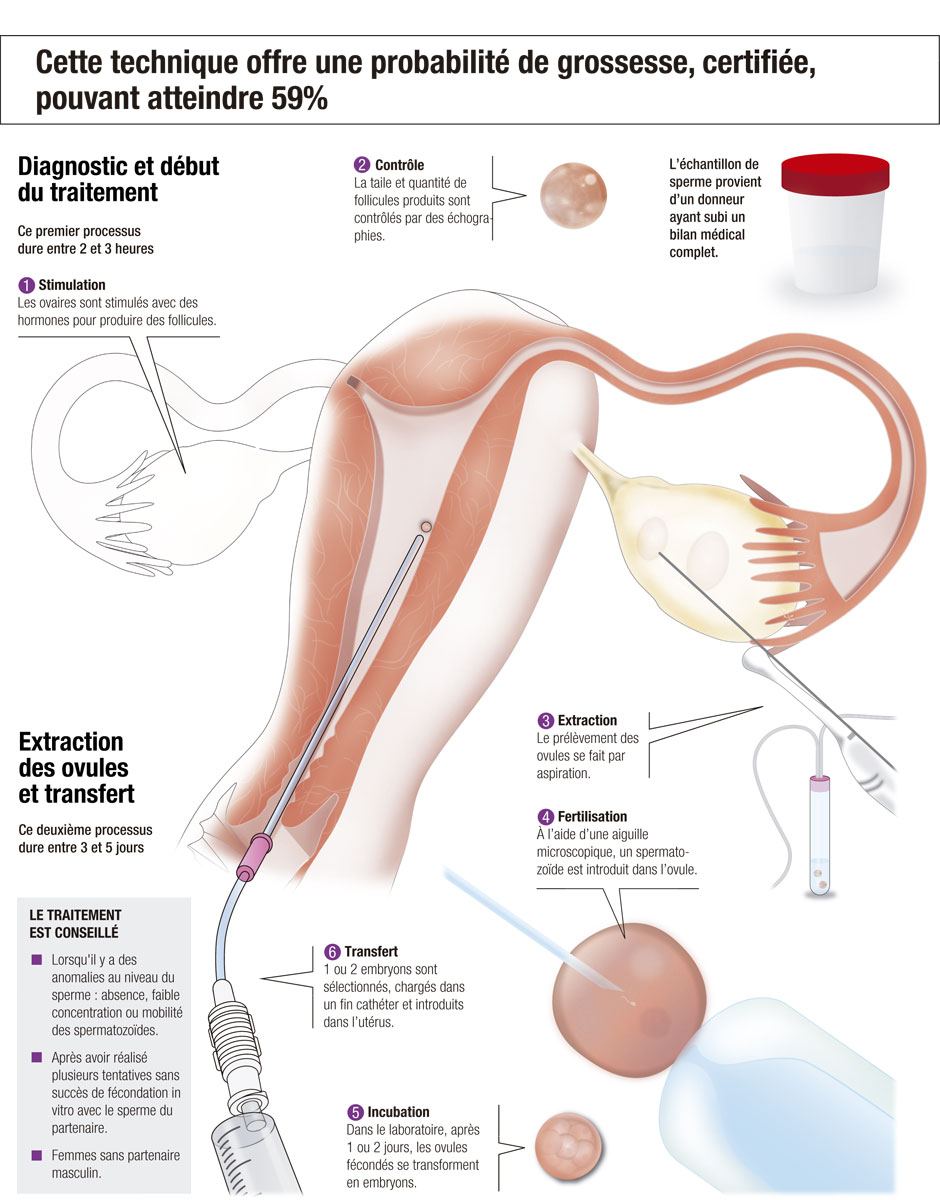 La Fécondation In Vitro avec vos propres ovules et le sperme d’un donneur, expliquée étape par étape