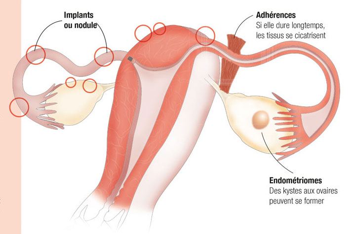 Comment l’endométriose affecte-t-elle votre fertilité ?