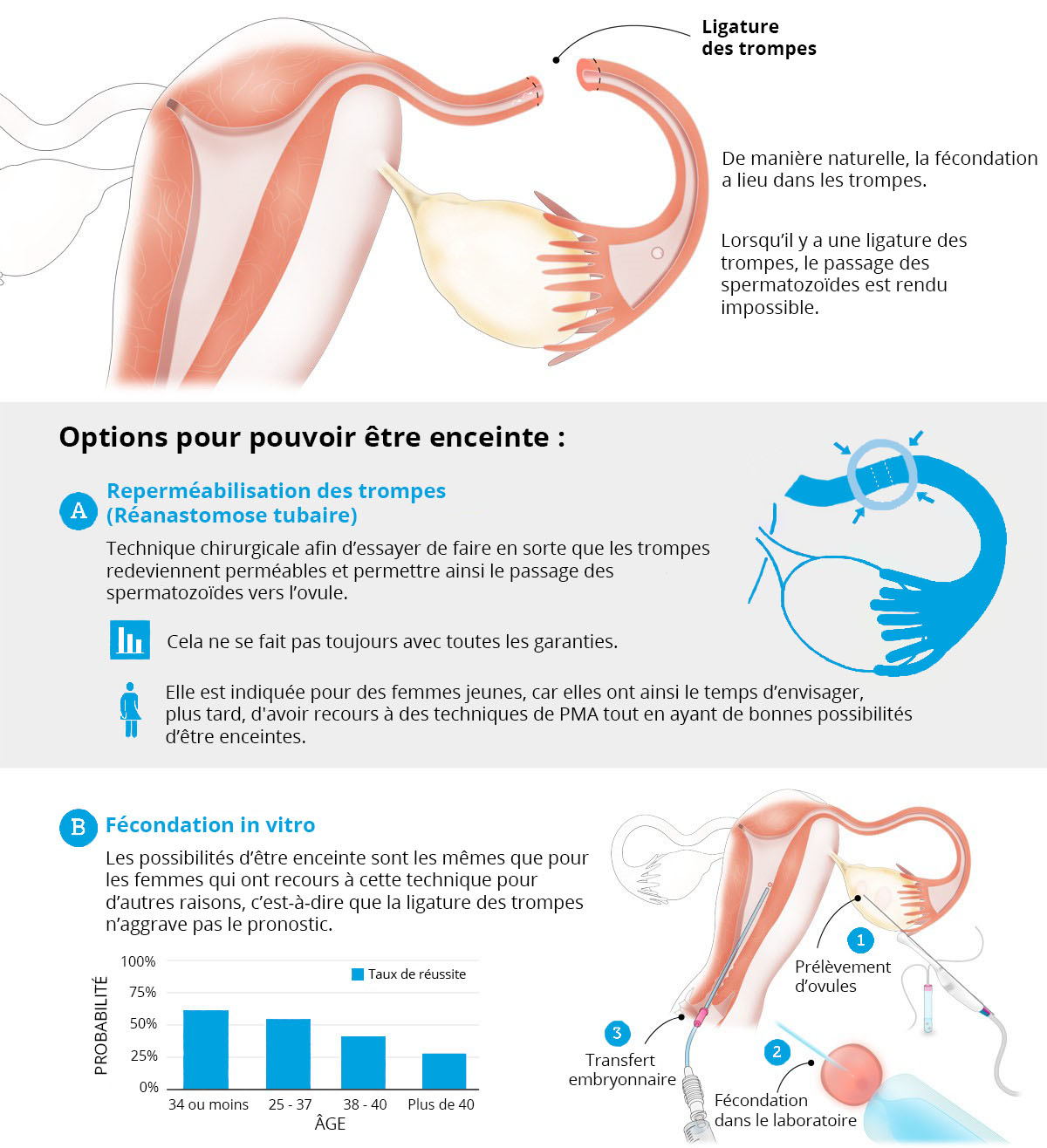 Peut-on être mère après une ligature de trompes ? Clinique Eugin